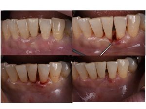 歯周病治療　歯周組織再生療法