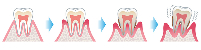 歯周病は歯を失う原因の第一位！